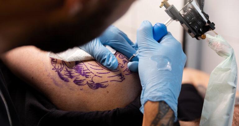 tattoo removal treatment